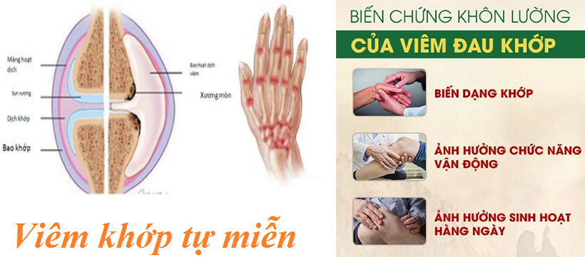 Các biến chứng của bệnh viêm khớp tự miễn-1.png