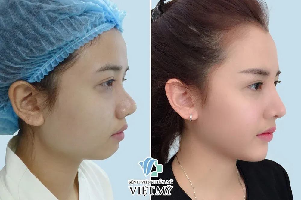 Hinh-anh-truoc-va-sau-nang-mui-cau-truc-s-Line-thu-gon-canh-mui-Don-cam-V-Line 1.jpg