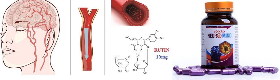 Nhồi máu não là gì-2.jpg