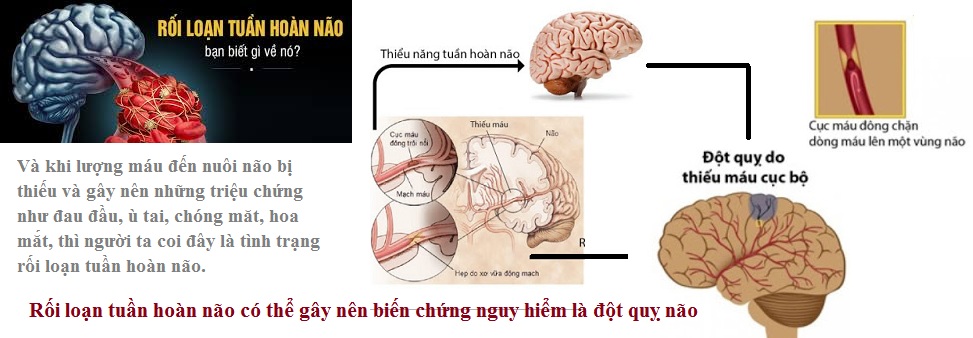 Rối loạn tuần hoàn não và biến chứng đột quỵ não1.jpg