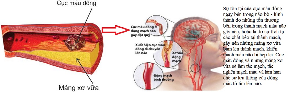 Sự hình thành của cục máu đông bên trong não bộ-1.jpg